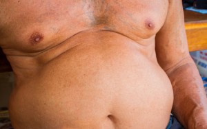 Skrämmande ökning av övervikt och diabetes världen över.